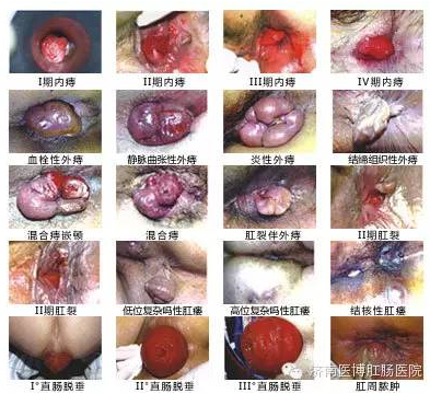 赤峰内痔和外痔两种痔疮要怎么去区分?