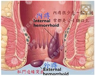大连金州翁牛特旗痔疮出血有什么危害?